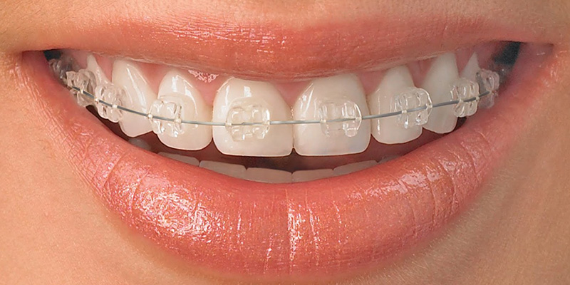 Çapraşık Diş Tedavisi (Ortodonti)